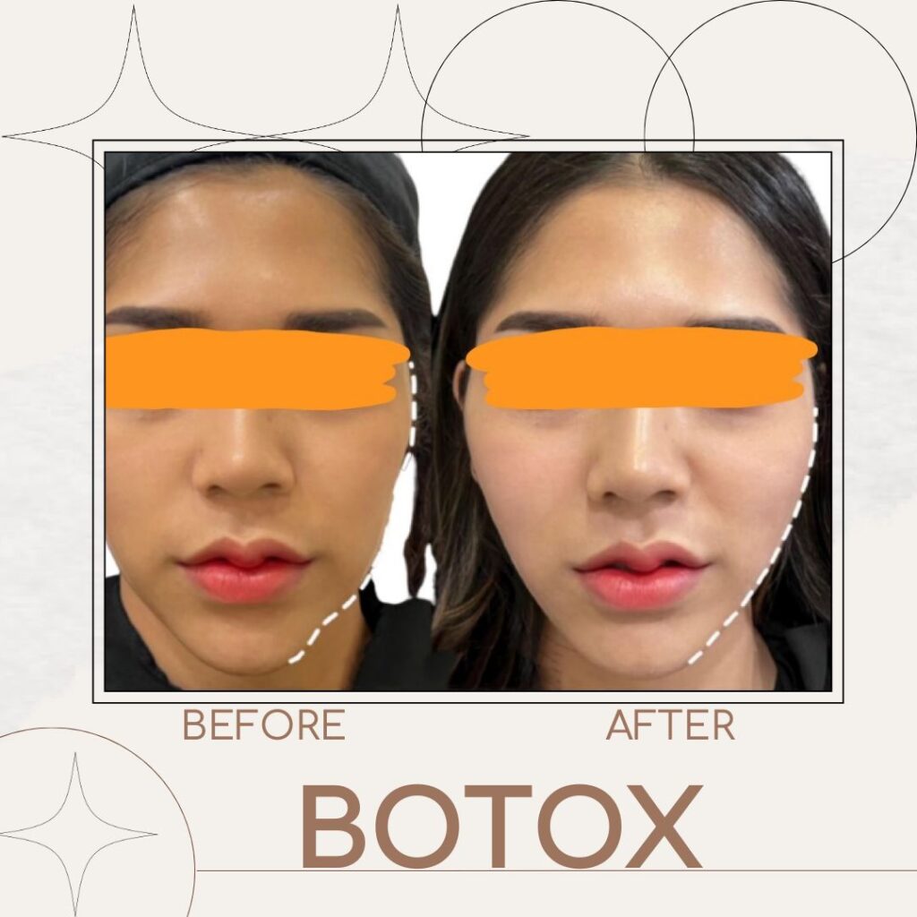 Botox01